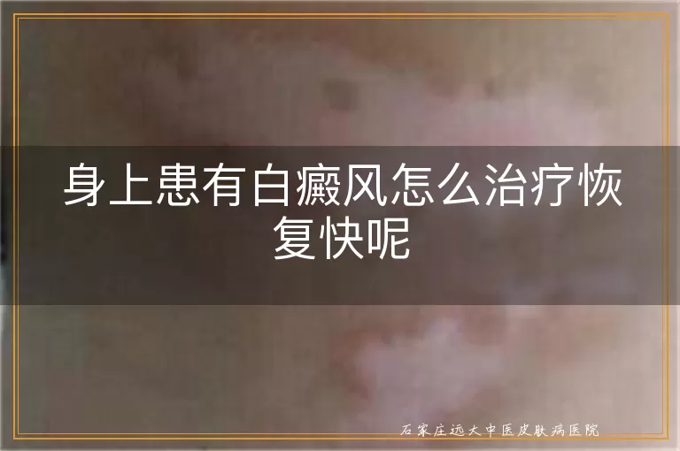 身上患有白癜风怎么治疗恢复快呢