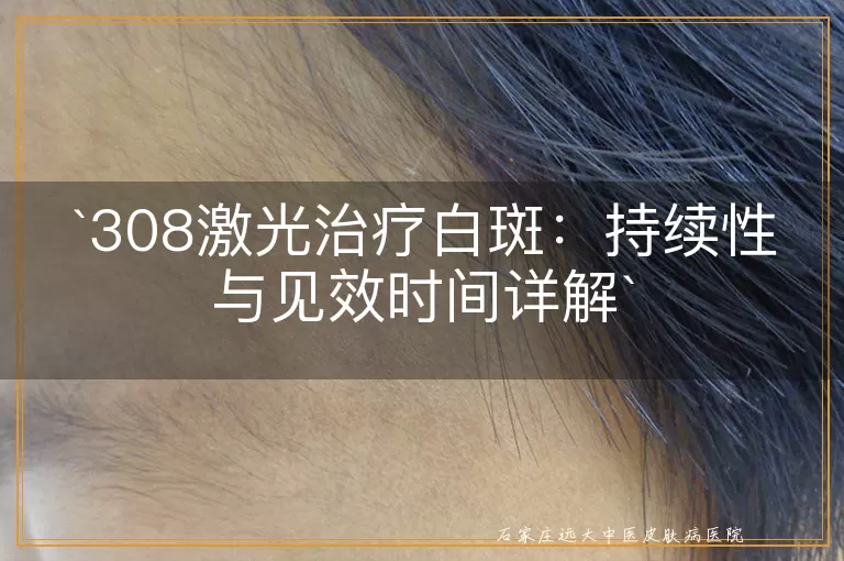 308激光治疗白斑：持续性与见效时间详解