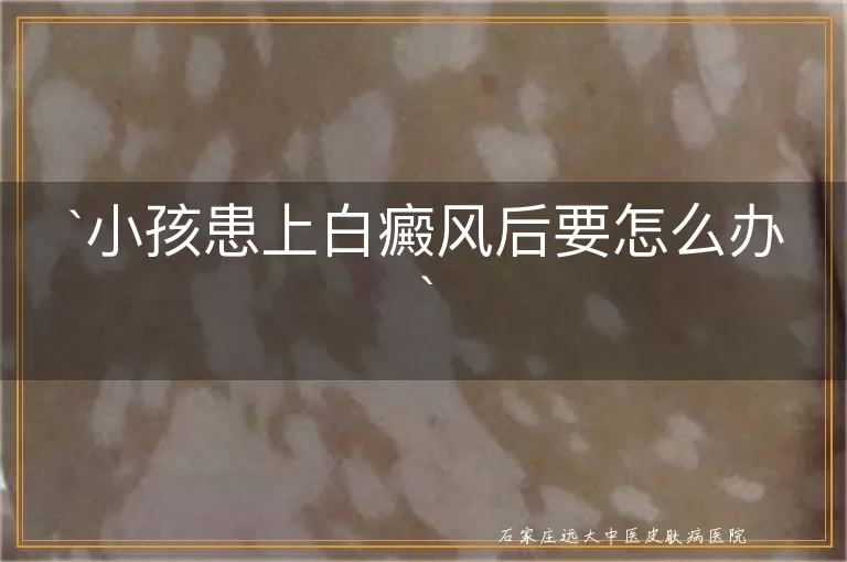 小孩患上白癜风后要怎么办