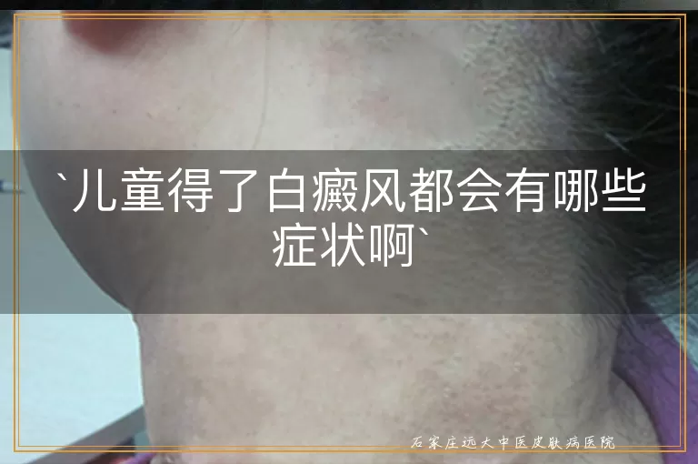 儿童得了白癜风都会有哪些症状啊