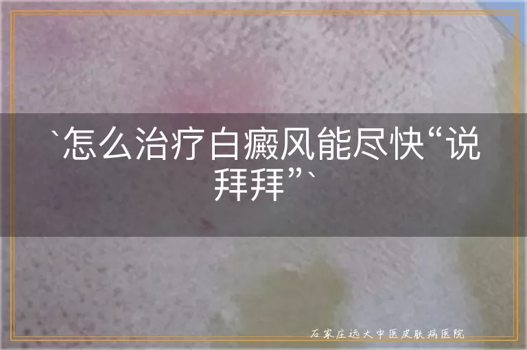 怎么治疗白癜风能尽快“说拜拜”