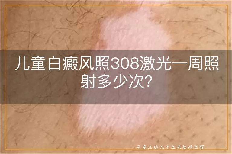 儿童白癜风照308激光一周照射多少次？