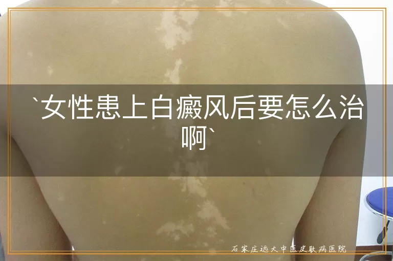女性患上白癜风后要怎么治啊