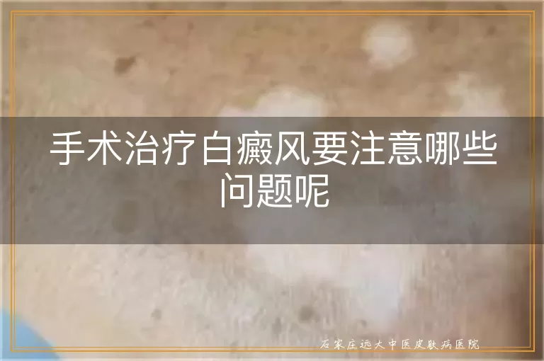 手术治疗白癜风要注意哪些问题呢