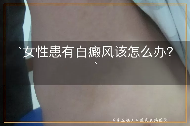 女性患有白癜风该怎么办？