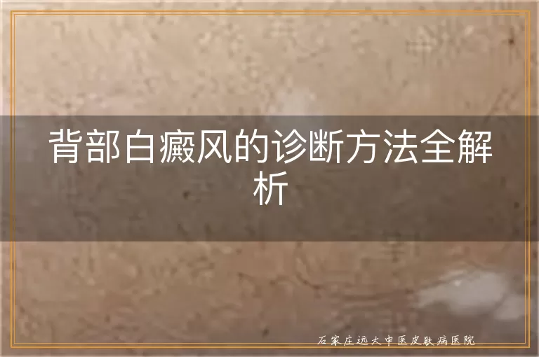 背部白癜风的诊断方法全解析