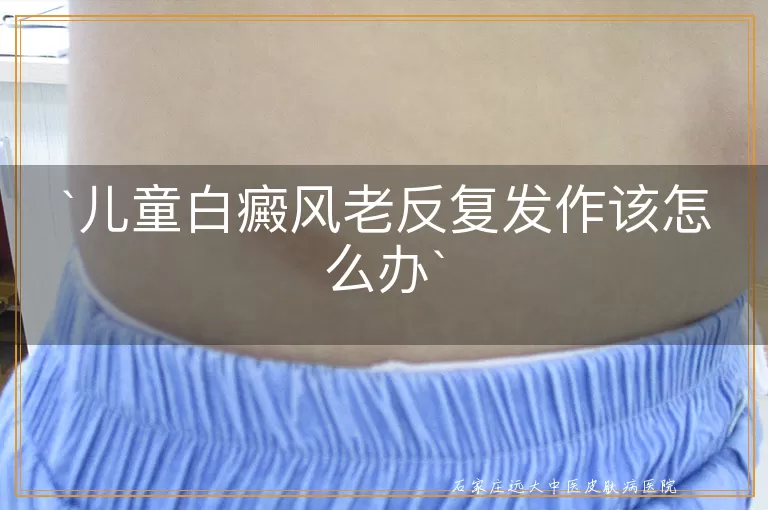 儿童白癜风老反复发作该怎么办