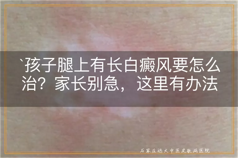 孩子腿上有长白癜风要怎么治？家长别急，这里有办法！