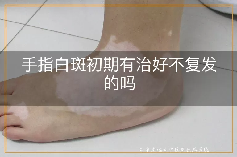 手指白斑初期有治好不复发的吗