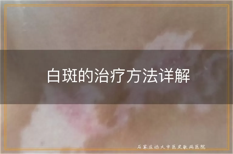 白斑的治疗方法详解