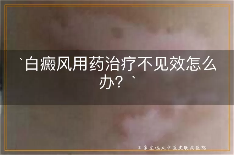 白癜风用药治疗不见效怎么办？