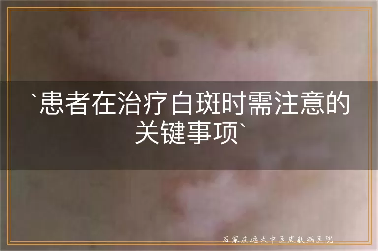 患者在治疗白斑时需注意的关键事项