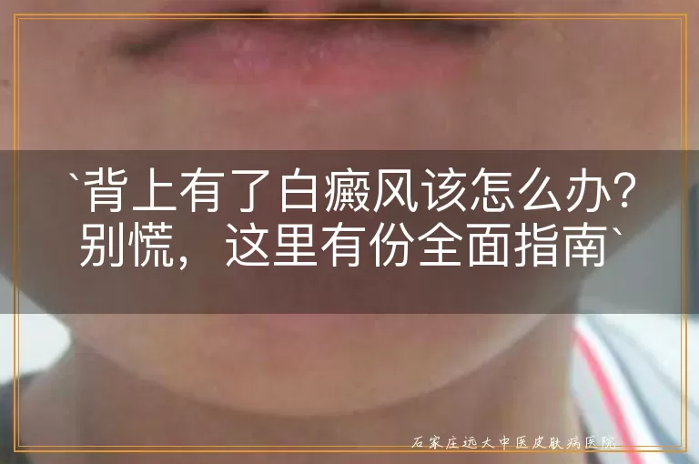 背上有了白癜风该怎么办？别慌，这里有份全面指南