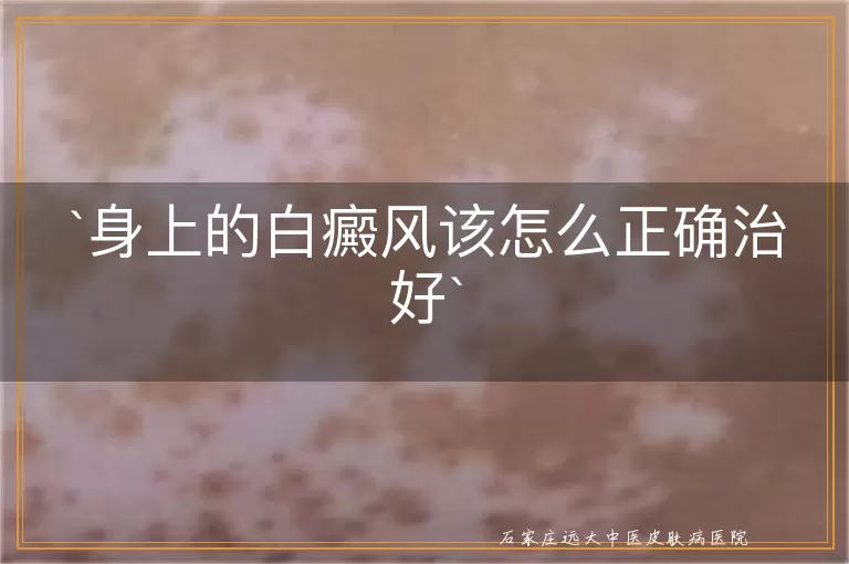 身上的白癜风该怎么正确治好