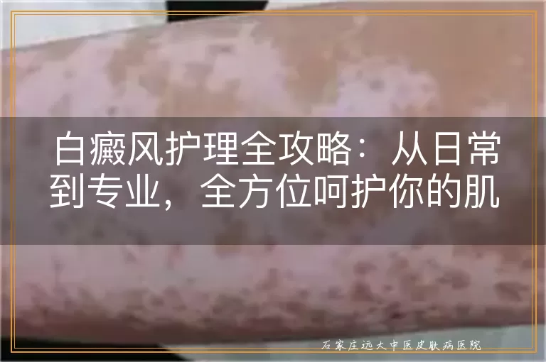 白癜风护理全攻略：从日常到专业，全方位呵护你的肌肤