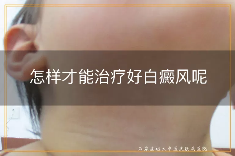 怎样才能治疗好白癜风呢