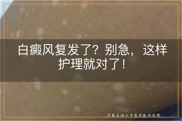 白癜风复发了？别急，这样护理就对了！