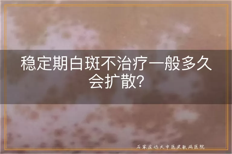 稳定期白斑不治疗一般多久会扩散？