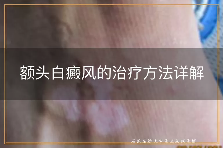 额头白癜风的治疗方法详解