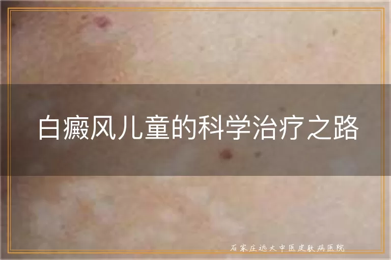 白癜风儿童的科学治疗之路
