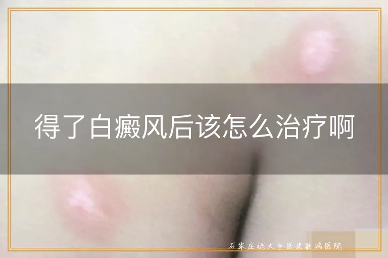 得了白癜风后该怎么治疗啊