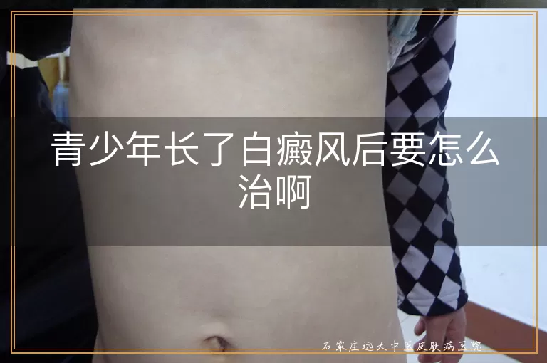 青少年长了白癜风后要怎么治啊