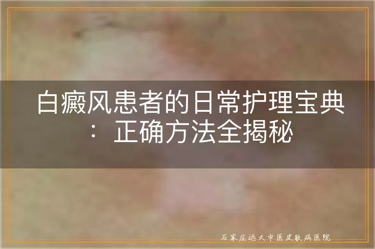 白癜风患者的日常护理宝典：正确方法全揭秘