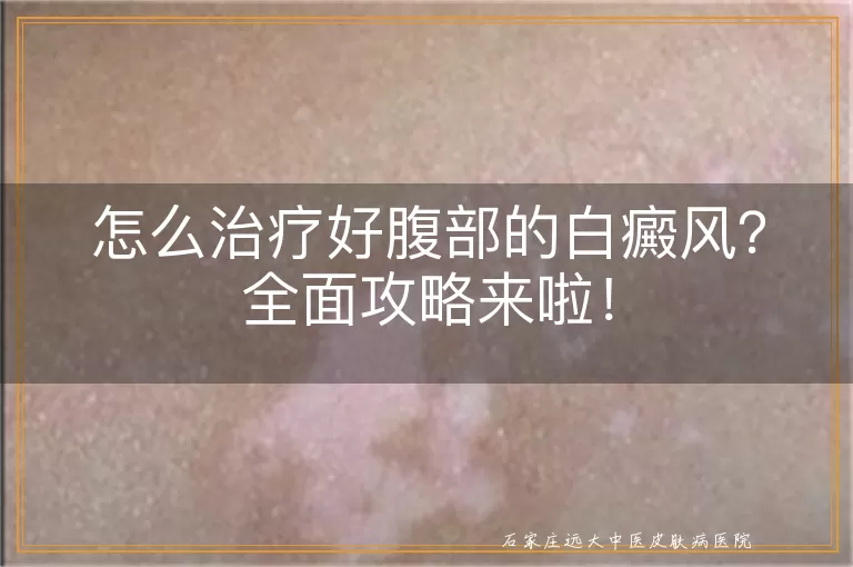 怎么治疗好腹部的白癜风？全面攻略来啦！