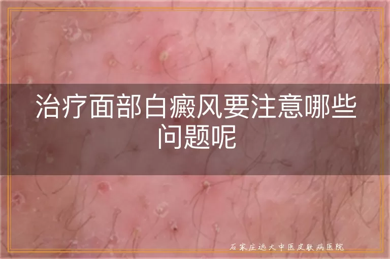 治疗面部白癜风要注意哪些问题呢