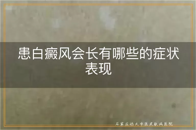 患白癜风会长有哪些的症状表现