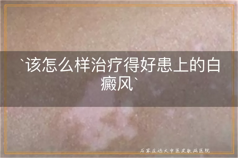 该怎么样治疗得好患上的白癜风