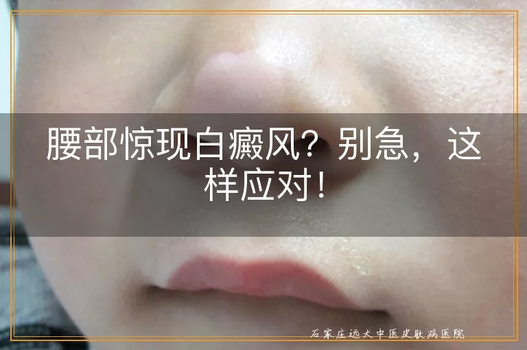 腰部惊现白癜风？别急，这样应对！
