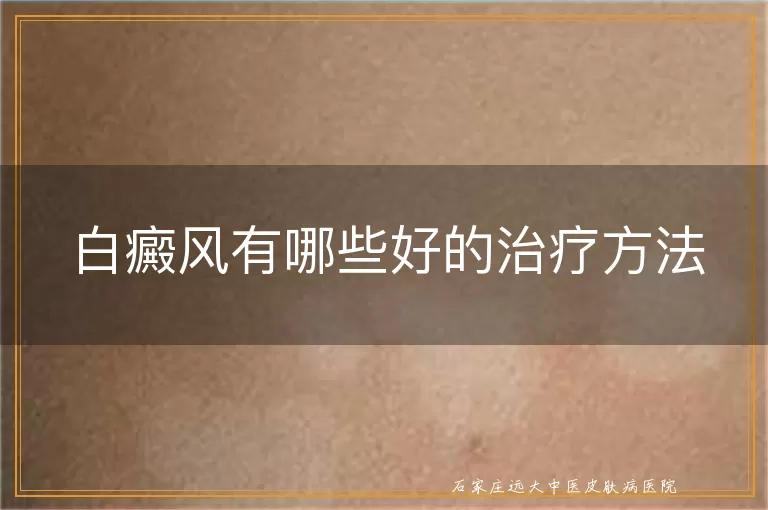 白癜风有哪些好的治疗方法