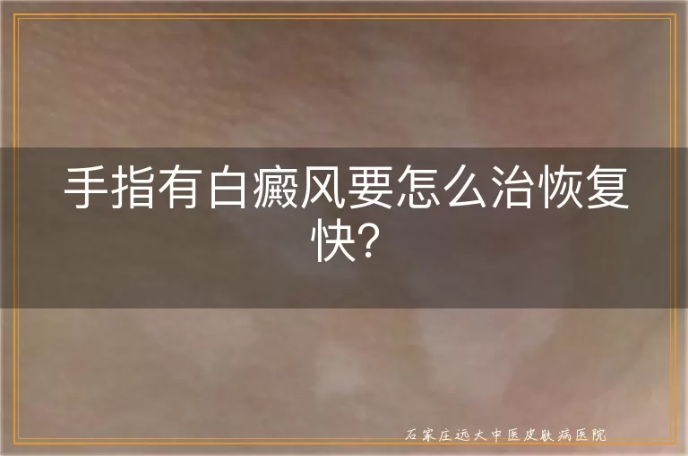手指有白癜风要怎么治恢复快？