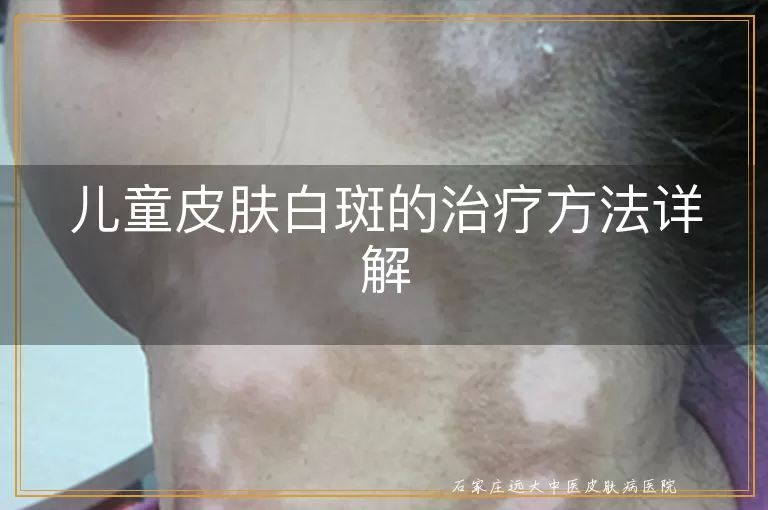 儿童皮肤白斑的治疗方法详解