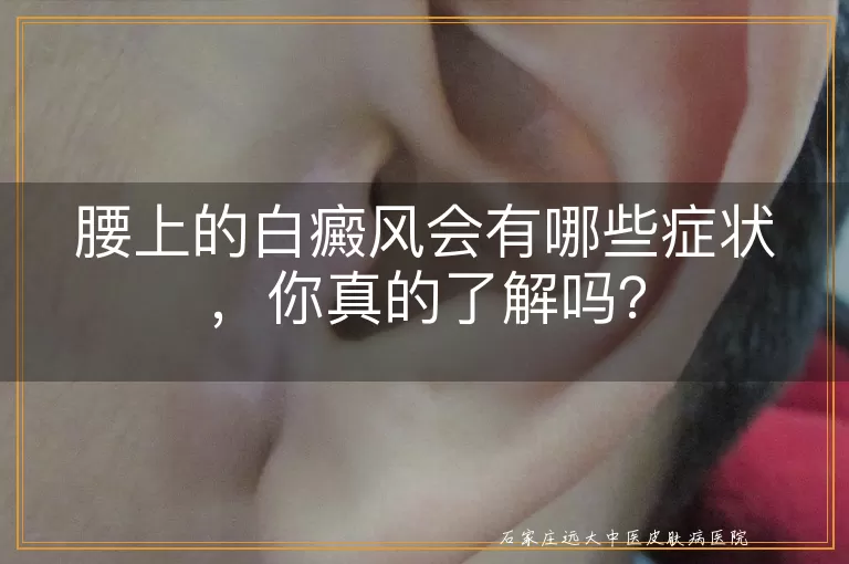 腰上的白癜风会有哪些症状，你真的了解吗？