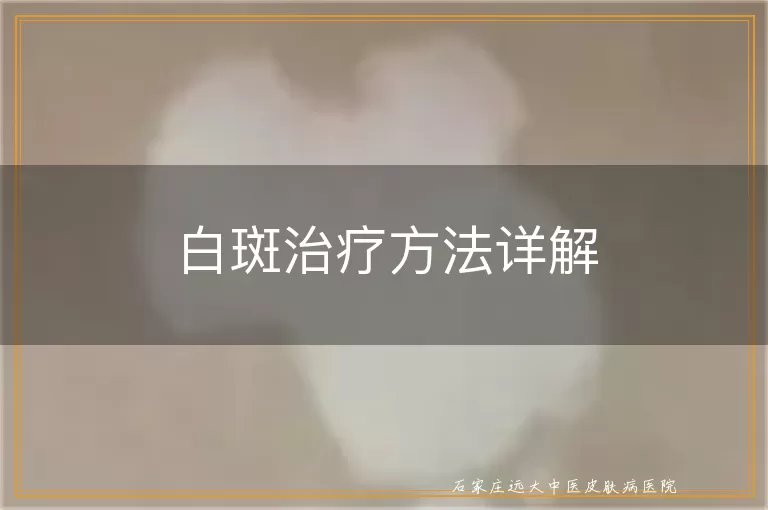 白斑治疗方法详解