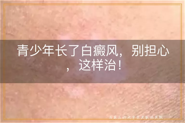 青少年长了白癜风，别担心，这样治！