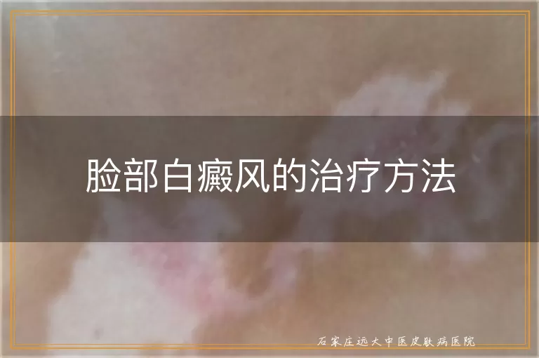 脸部白癜风的治疗方法