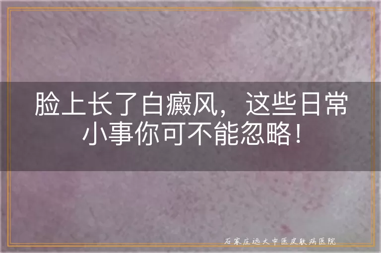 脸上长了白癜风，这些日常小事你可不能忽略！