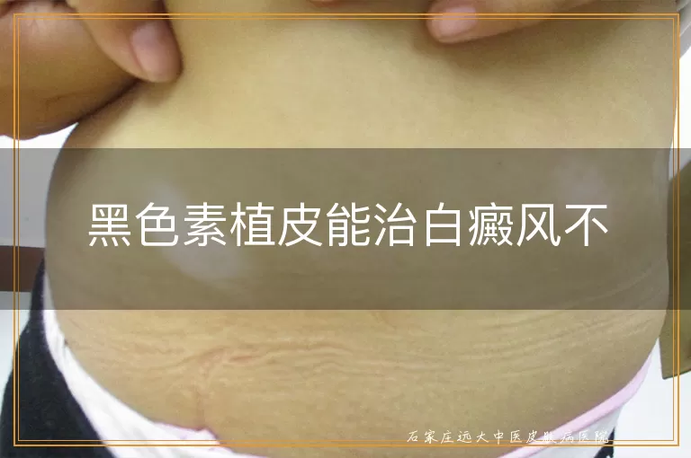 黑色素植皮能治白癜风不