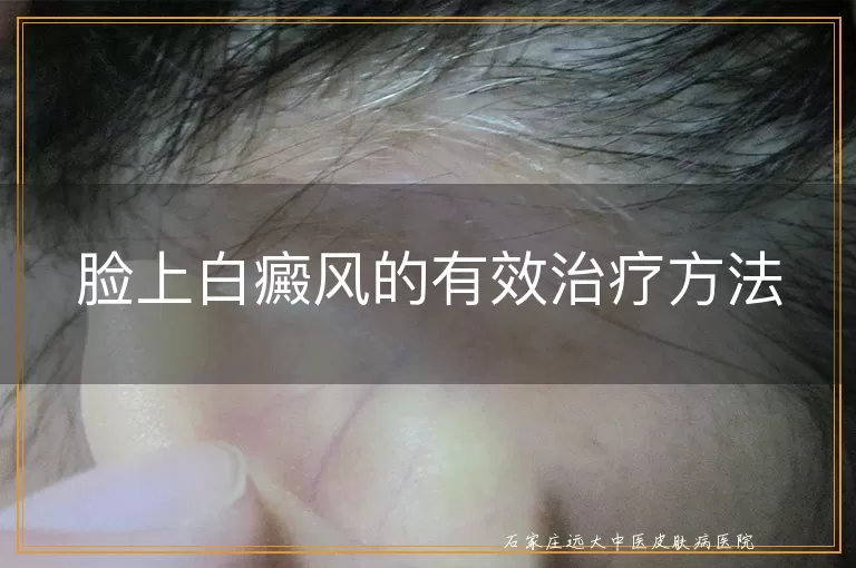 脸上白癜风的有效治疗方法