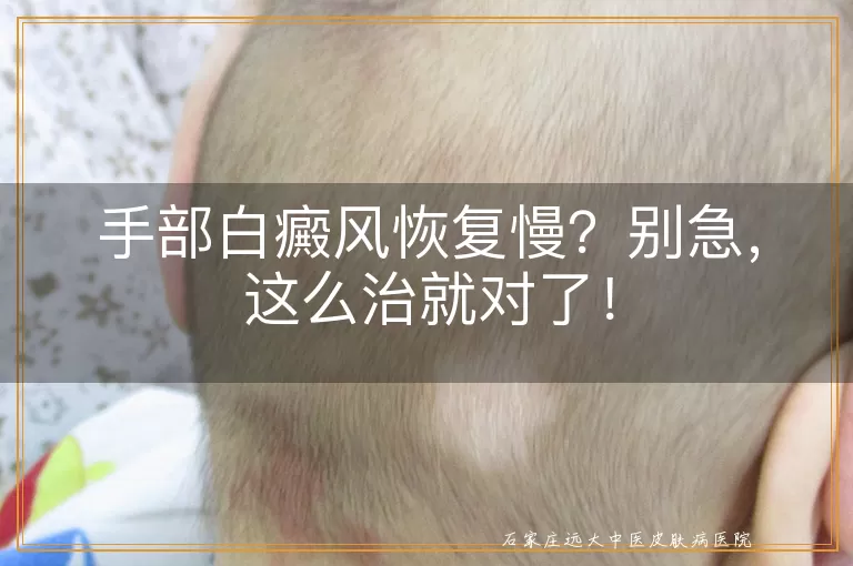 手部白癜风恢复慢？别急，这么治就对了！