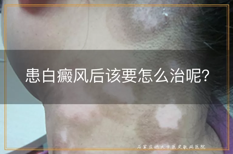患白癜风后该要怎么治呢？