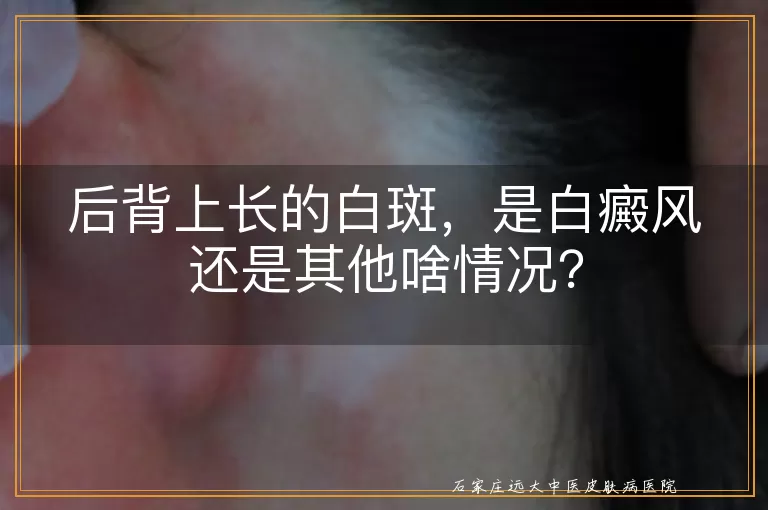 后背上长的白斑，是白癜风还是其他啥情况？