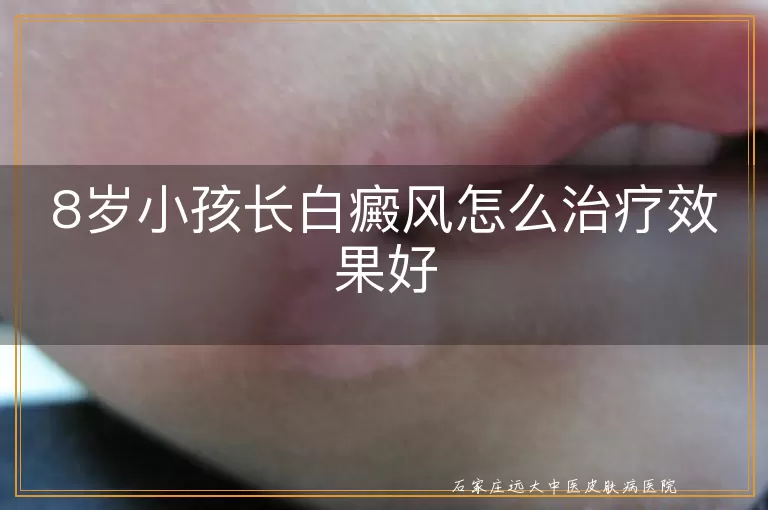 8岁小孩长白癜风怎么治疗效果好