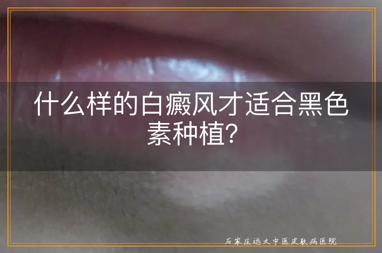 什么样的白癜风才适合黑色素种植？