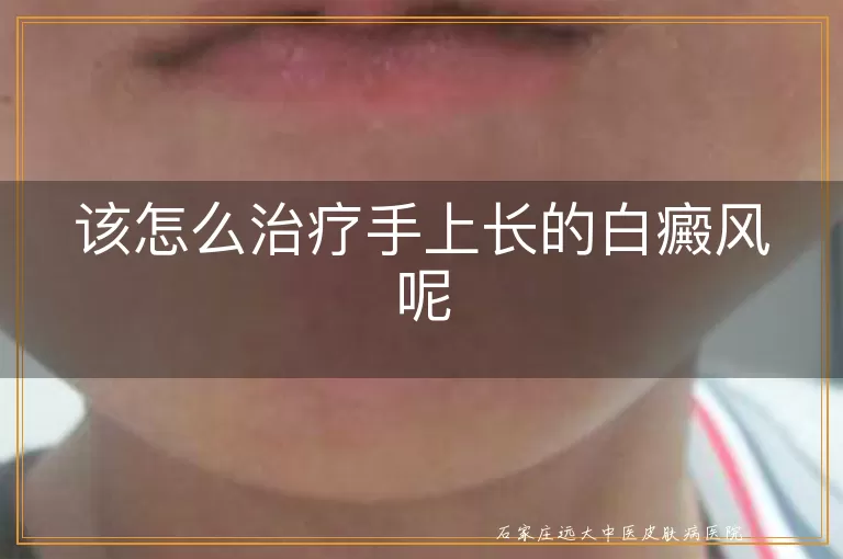 该怎么治疗手上长的白癜风呢