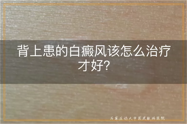 背上患的白癜风该怎么治疗才好？