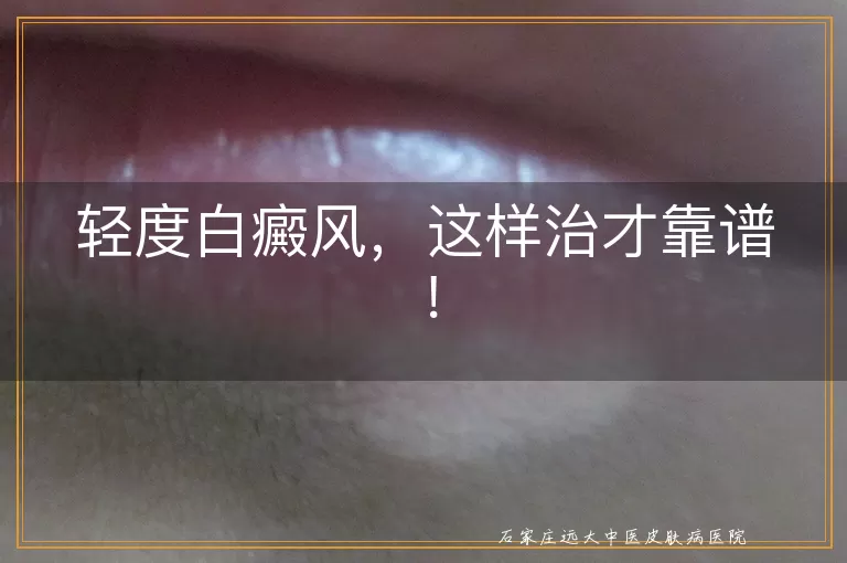 轻度白癜风，这样治才靠谱！